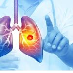 Her Yıl 25 Bin Akciğer Kanseri Vakası Önlenebilir