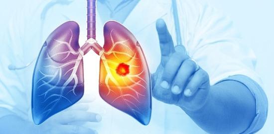 Her Yıl 25 Bin Akciğer Kanseri Vakası Önlenebilir