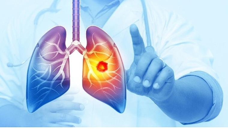 Her Yıl 25 Bin Akciğer Kanseri Vakası Önlenebilir