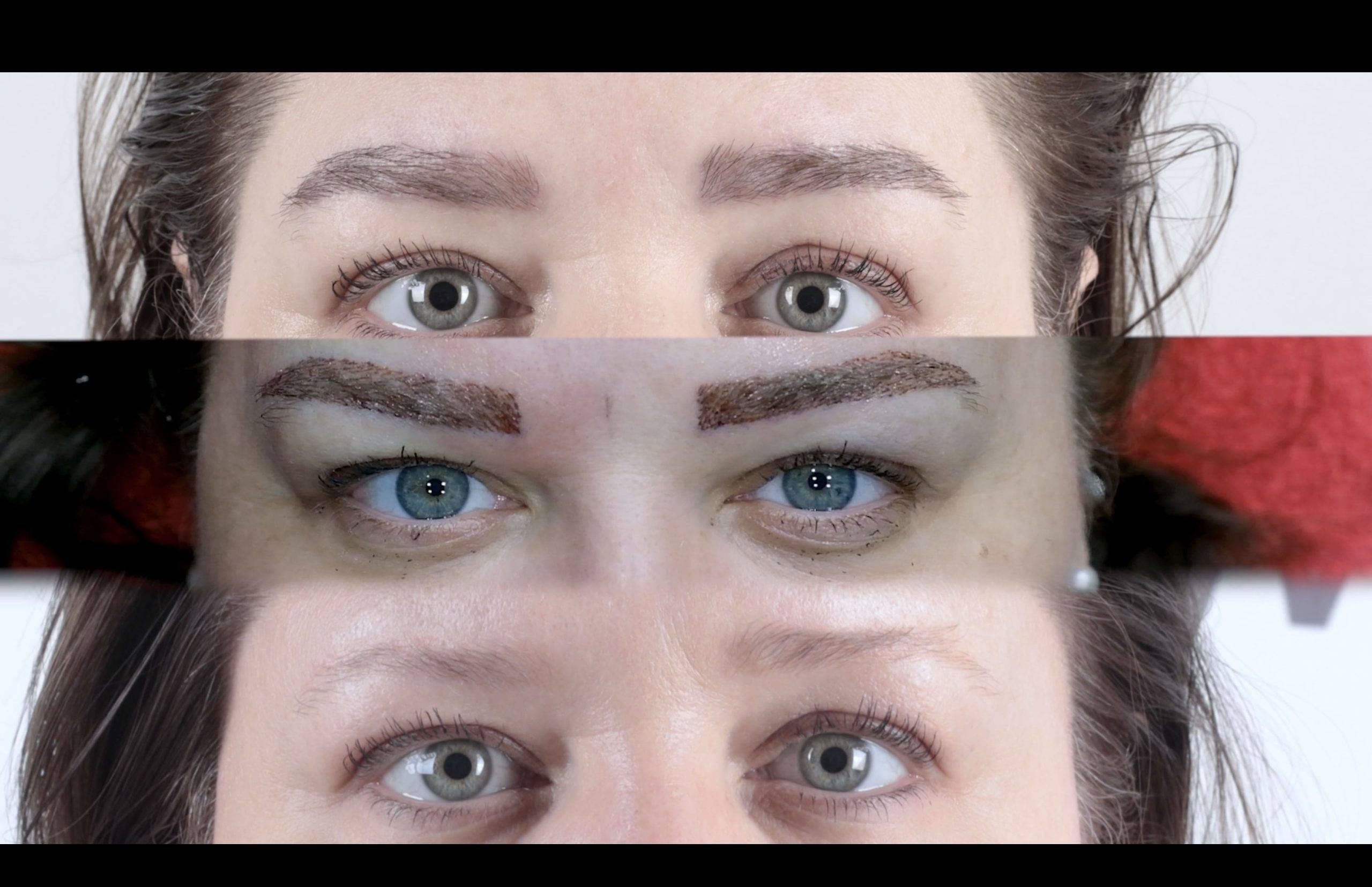 Micro Brow Implant Nedir? Micro Brow Implant Nedir?